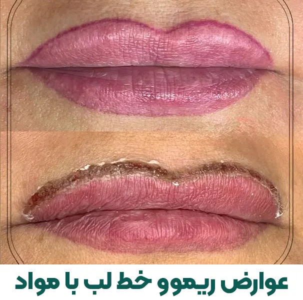عوارض ریموو خط لب با مواد