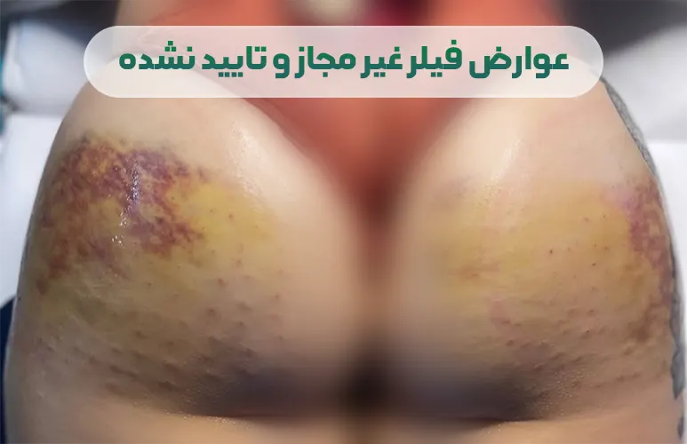 عوارض فیلر باسن غیر مجاز و تایید نشده