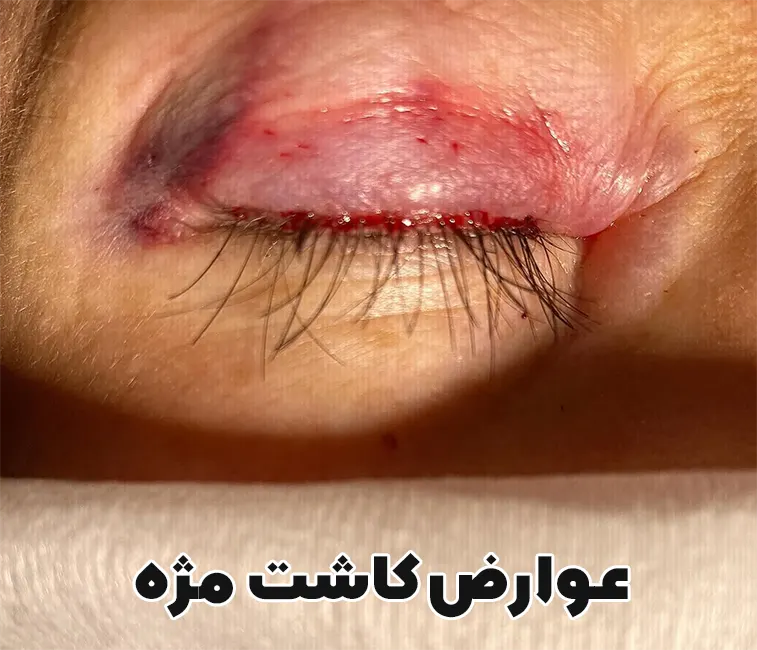 عوارض کاشت مژه