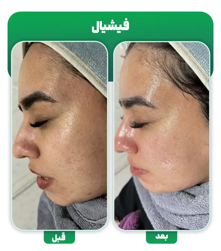 قبل و بعد فشیال پوست