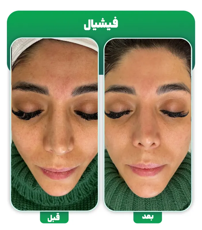 قبل و بعد فشیال تخصصی پوست