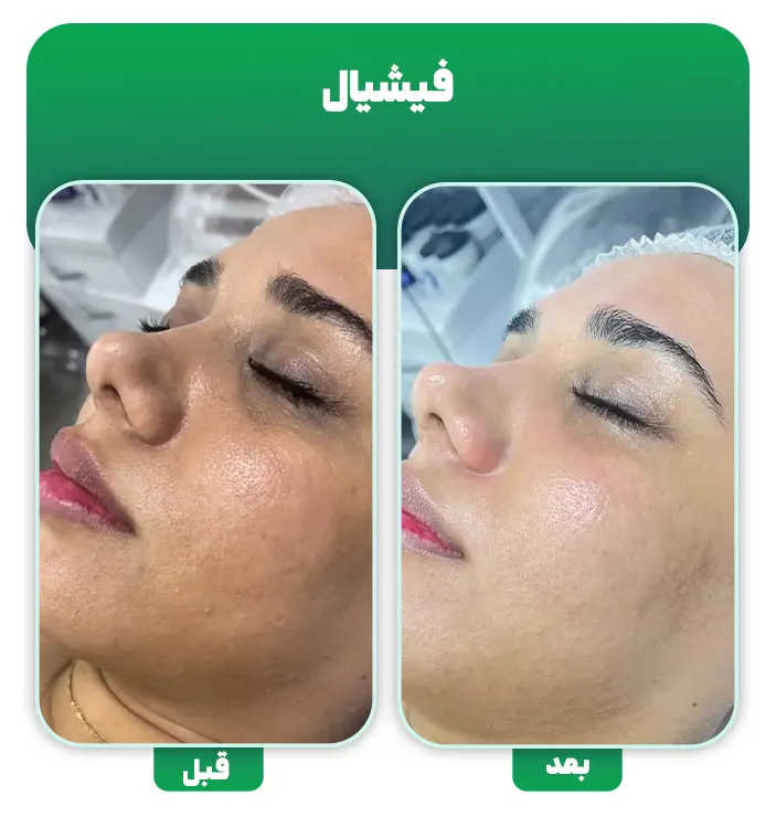 قبل و بعد فیشیال