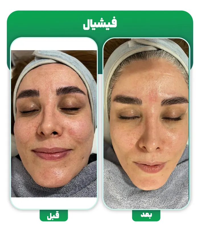 قبل و بعد فشیال تخصصی پوست