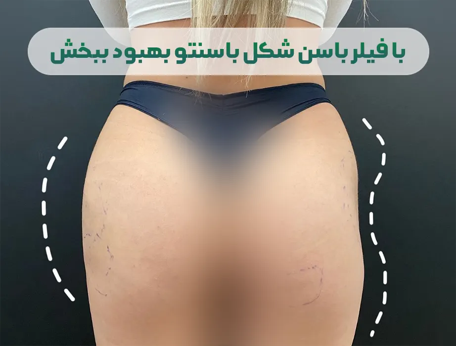 قبل و بعد فیلر باسن