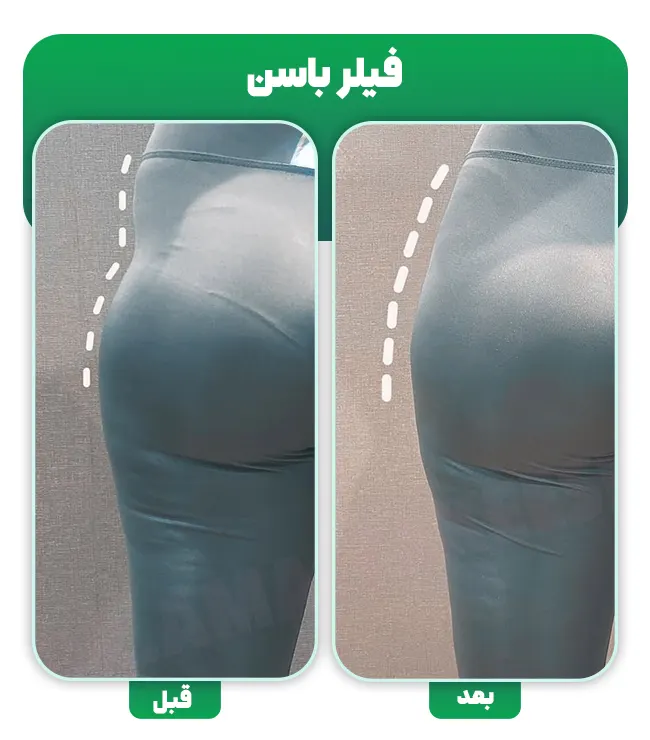 قبل و بعد فیلر باسن