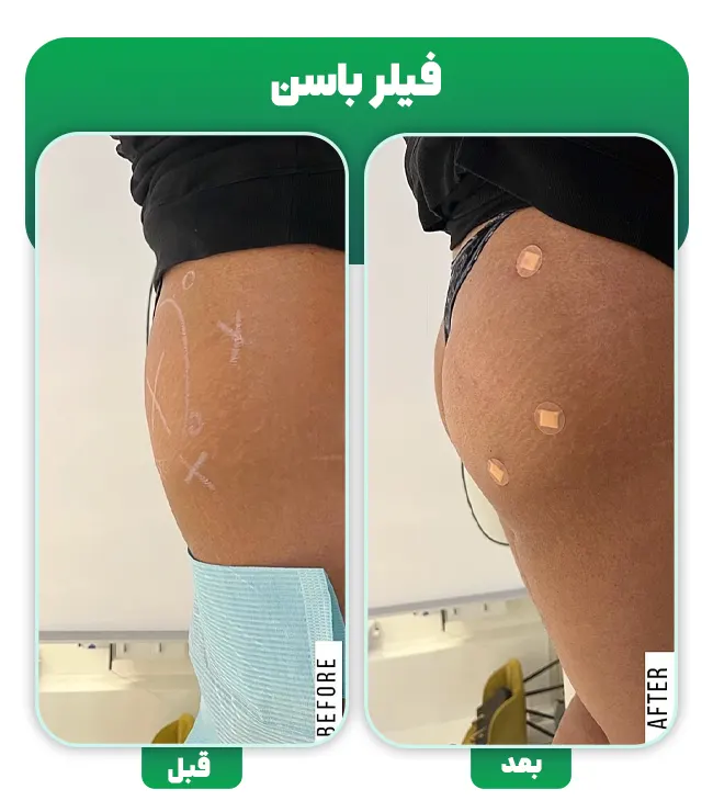 قبل و بعد فیلر باسن