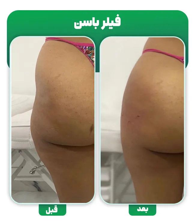 قبل و بعد فیلر باسن