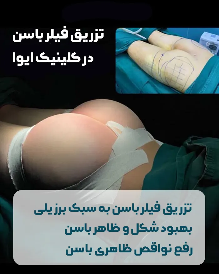 فیلر باسن در ایوا