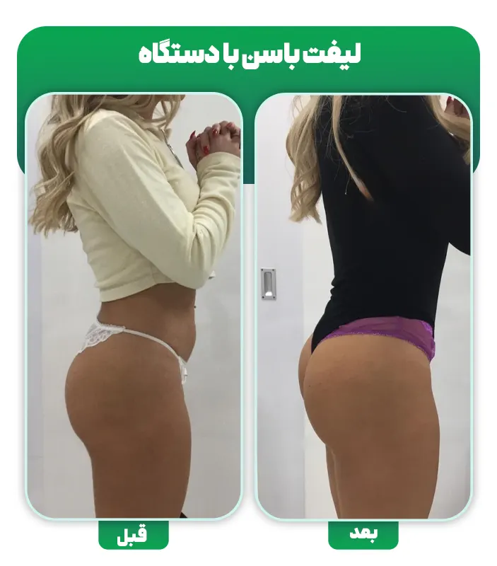 نتایج لیفت باسن با دستگاه