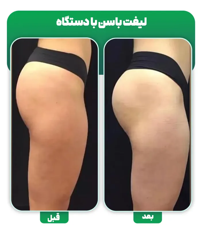 قبل بعد لیفت باسن با دستگاه