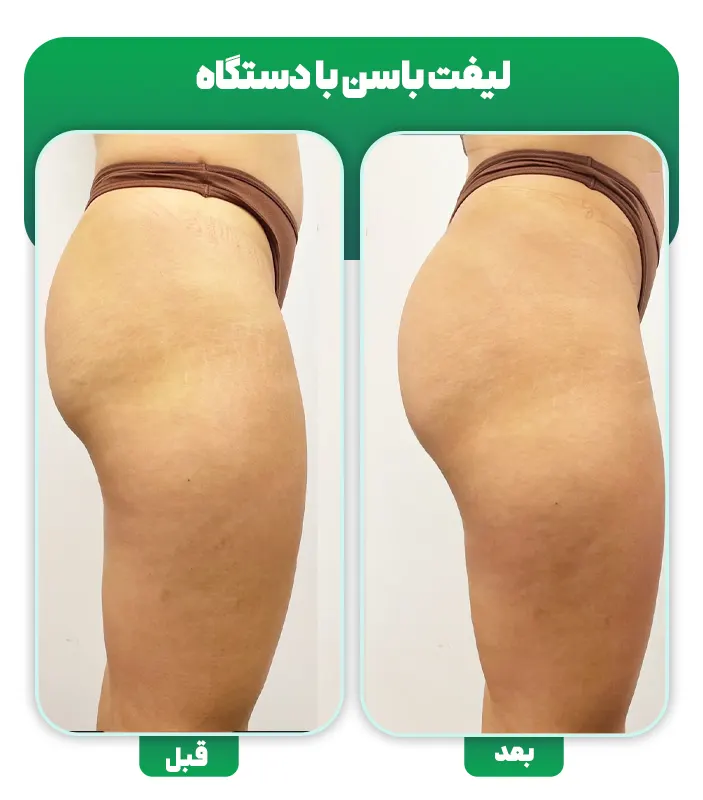 قبل بعد لیفت باسن با دستگاه