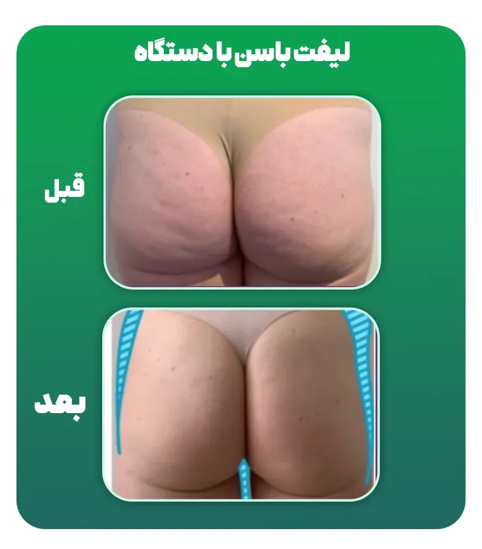 قبل بعد لیفت باسن با دستگاه