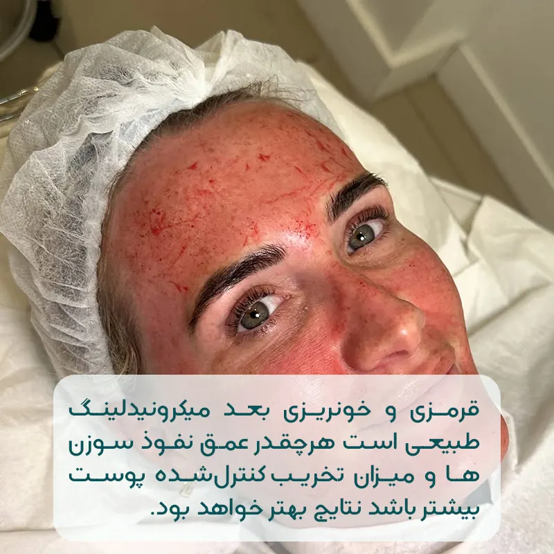 قرمزی بعد میکرونیدلینگ