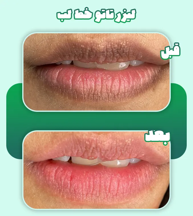 لیزر تاتو خط لب