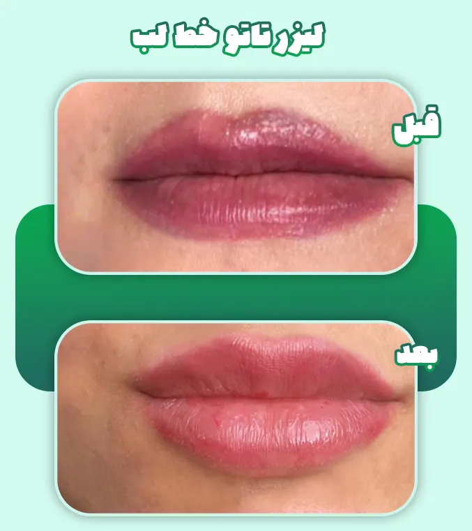 لیزر تاتو خط لب