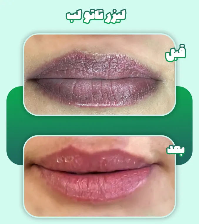 لیزر تاتو لب