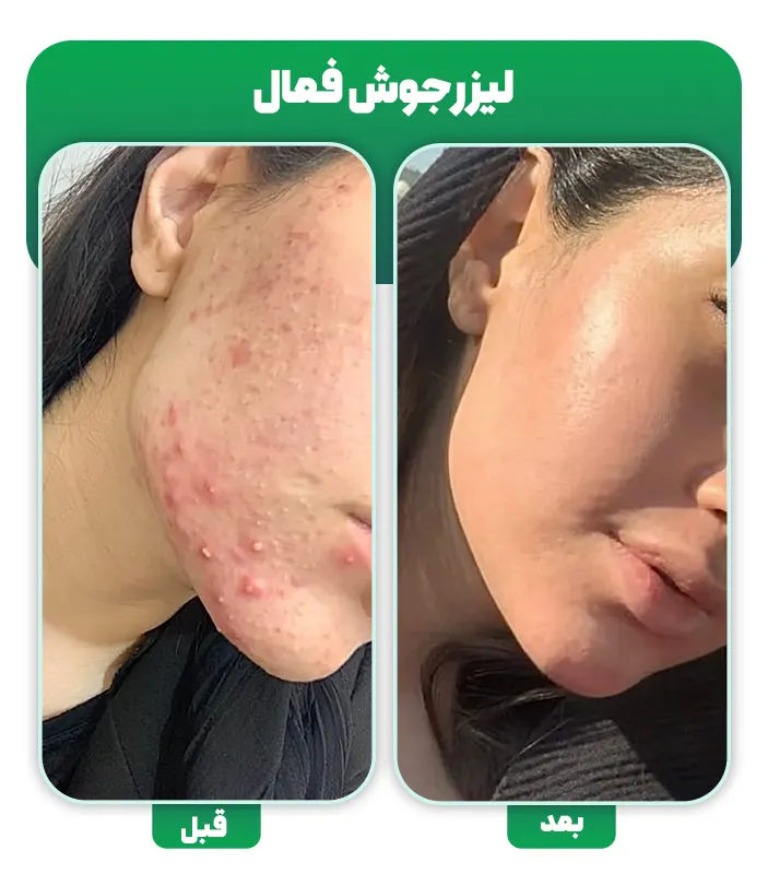 قبل و بعد لیزر جوش فعال