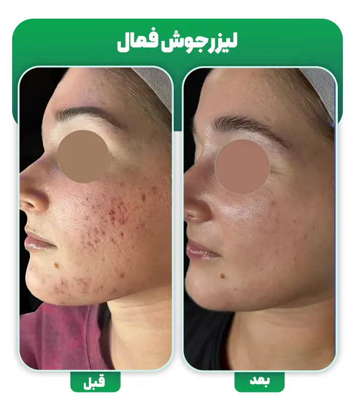 لیزر جوش فعال