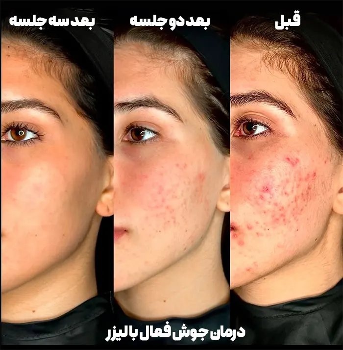 لیزر جوش فعال