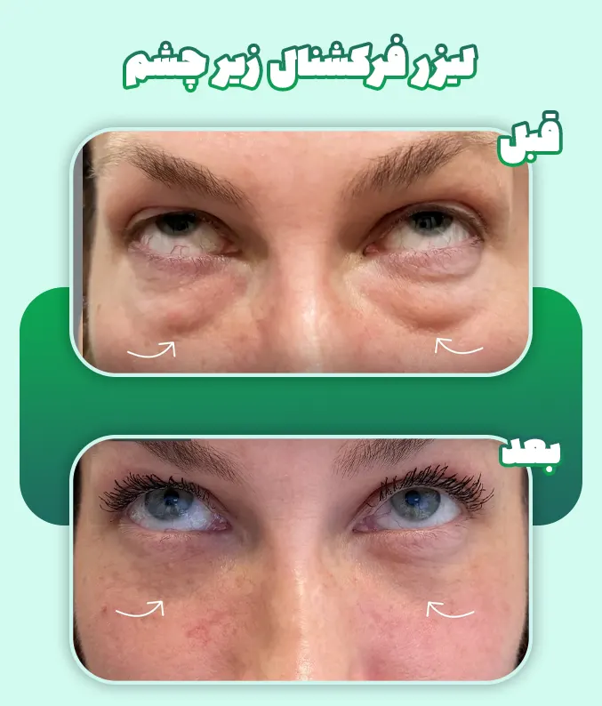 لیزر فرکشنال زیر چشم