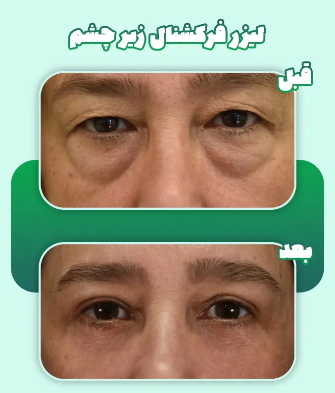 لیزر فرکشنال زیر چشم