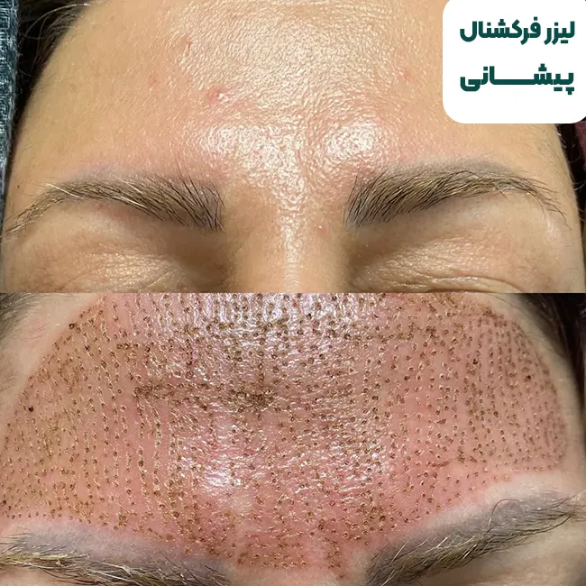 لیزر فرکشنال پیشانی