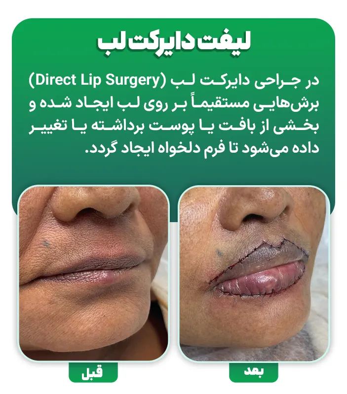 لیفت دایرکت لب