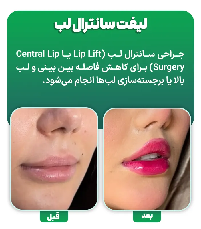 لیفت سانترال لب