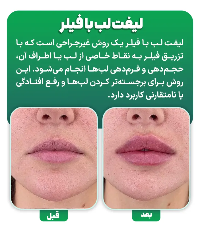 لیفت لب با فیلر