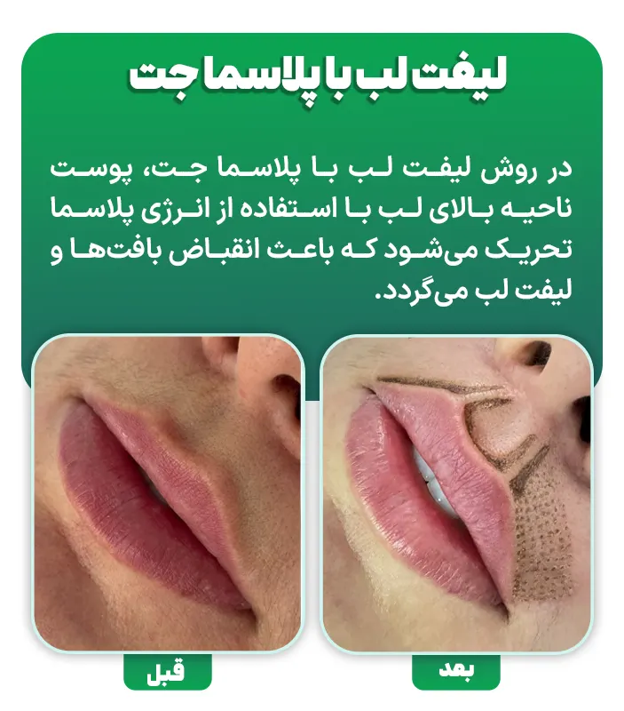 لیفت لب با پلاسماجت