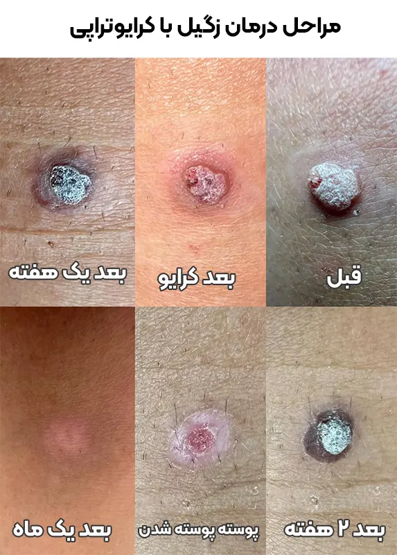 مراحل درمان زگیل با کرایوتراپی