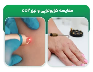 مقایسه کرایوتراپی و لیزر co2 در درمان زگیل تناسلی