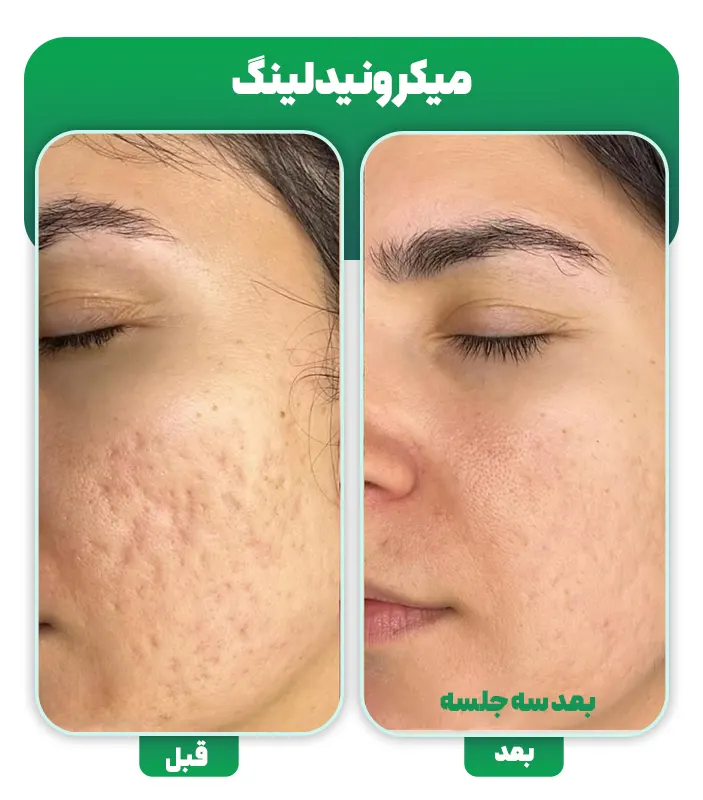 قبل و بعد میکرونیدلینگ