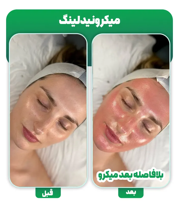 قبل و بعد میکرونیدلینگ