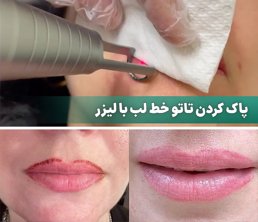 پاک کردن تاتو خط لب با لیزر