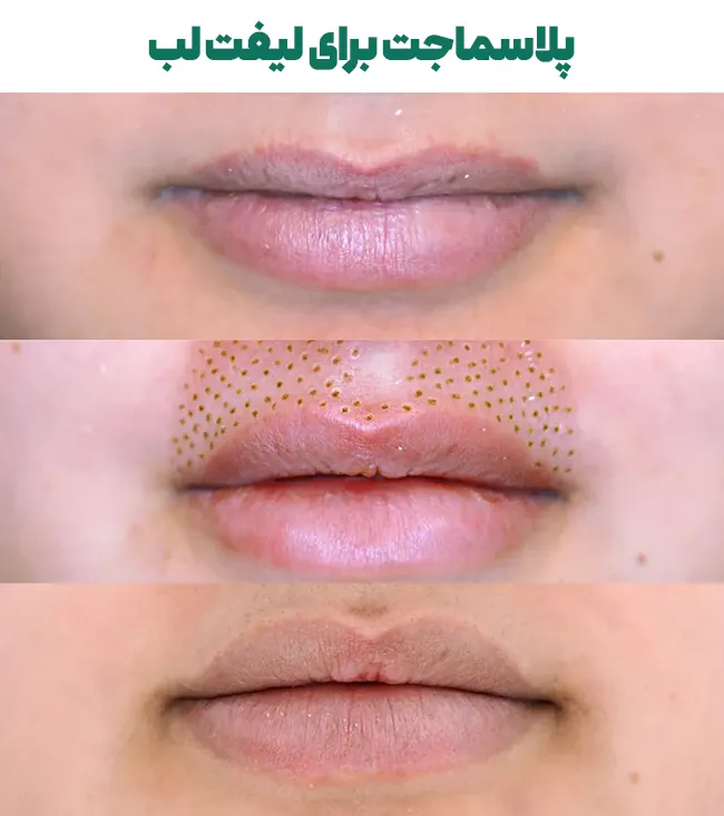 پلاسماجت برای لیفت لب