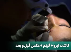 کاشت ابرو