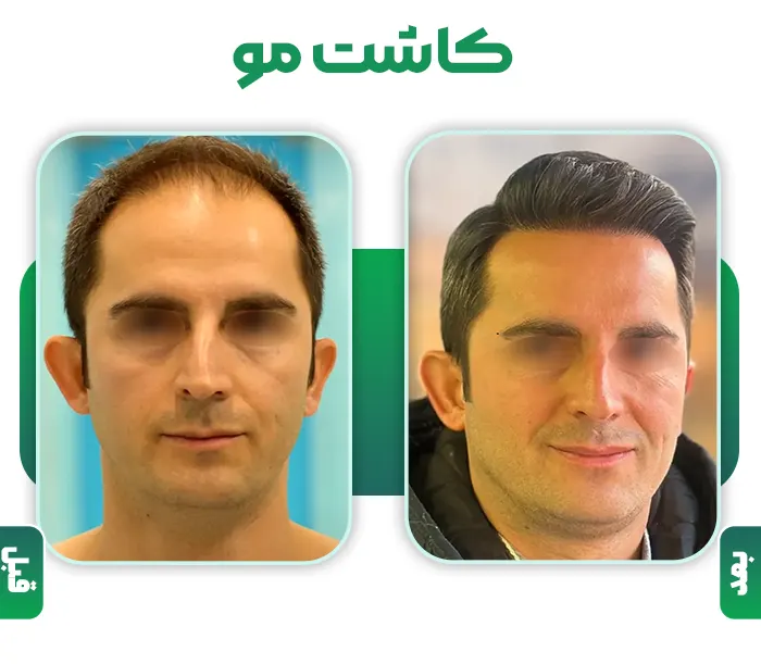 کاشت مو