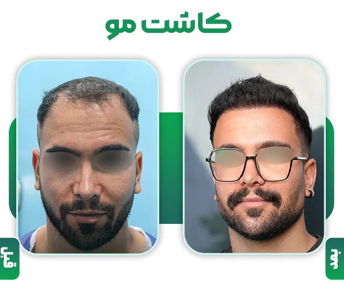 کاشت مو