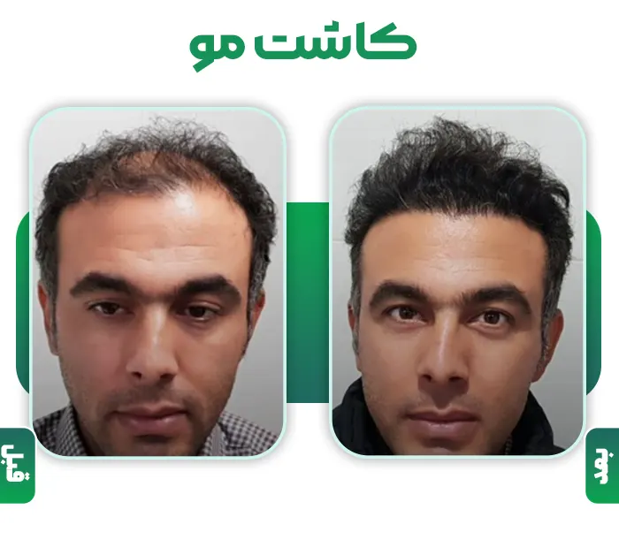کاشت مو