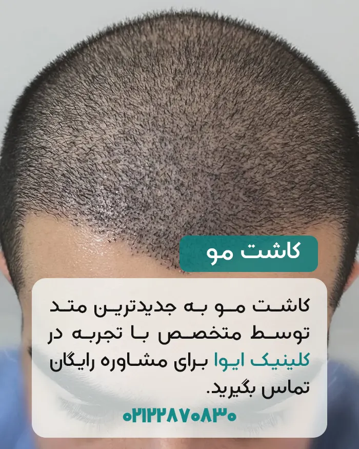 کاشت مو در کلینیک ایوا