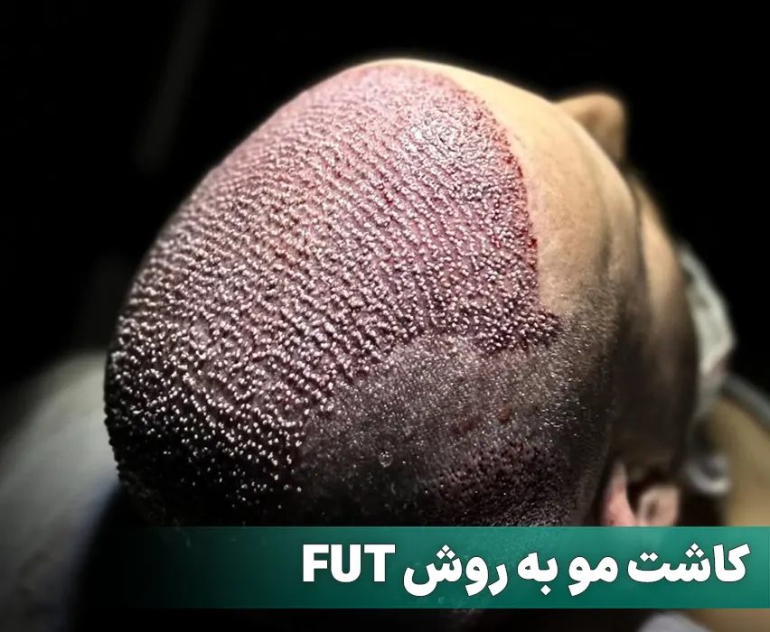 کاشت مو به روش FUT