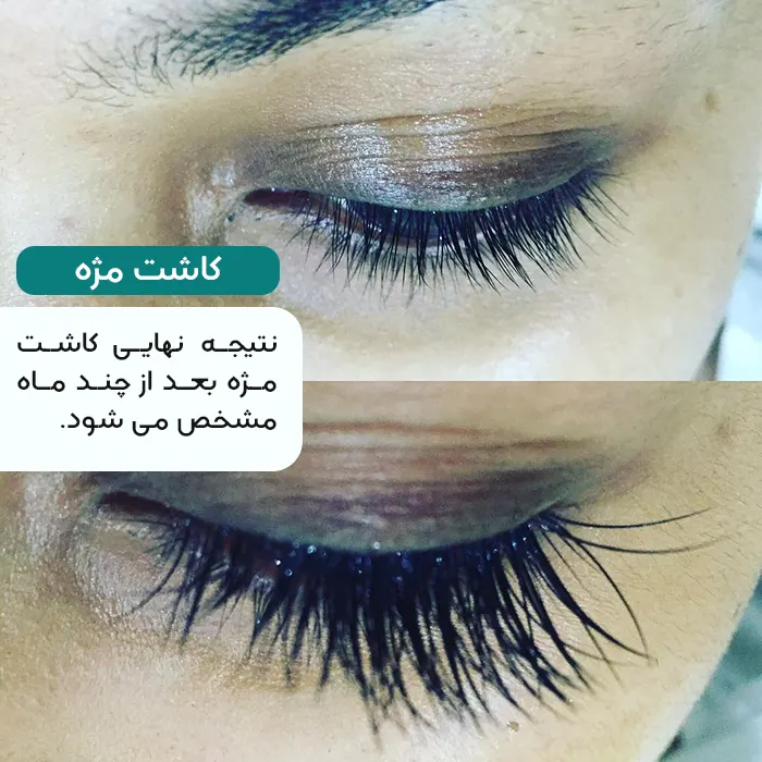 کاشت مژه