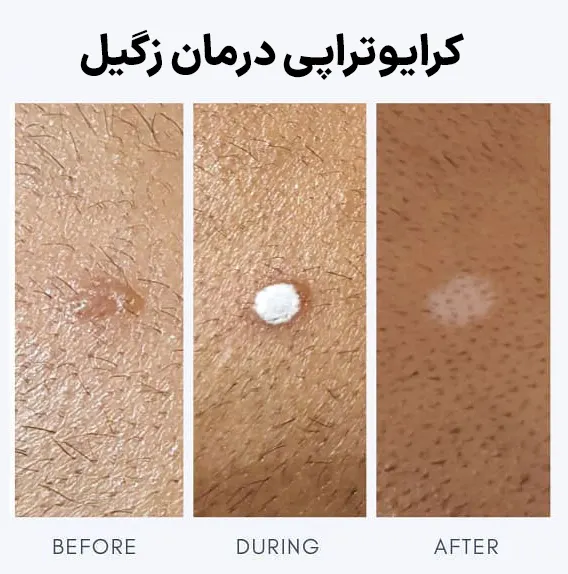 کرایوتراپی درمان زگیل