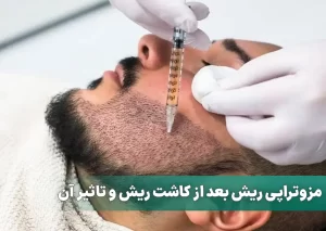 مزوتراپی ریش بعد از کاشت ریش