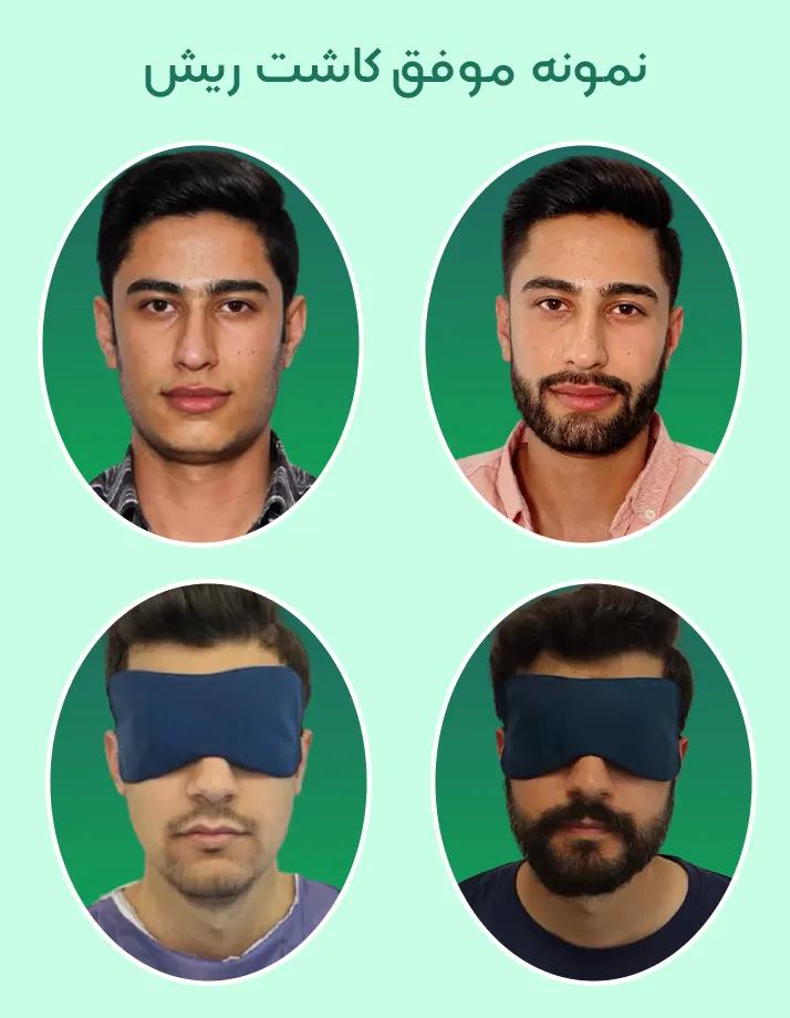 کاشت ریش