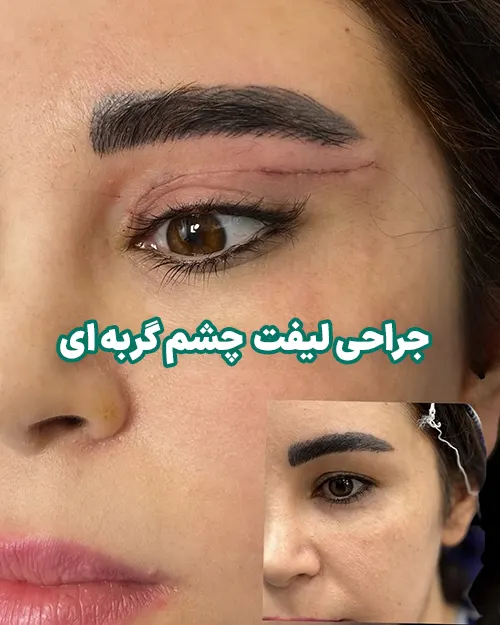جراحی لیفت چشم گربه ای