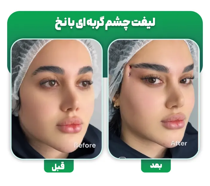 لیفت چشم گربه ای با نخ