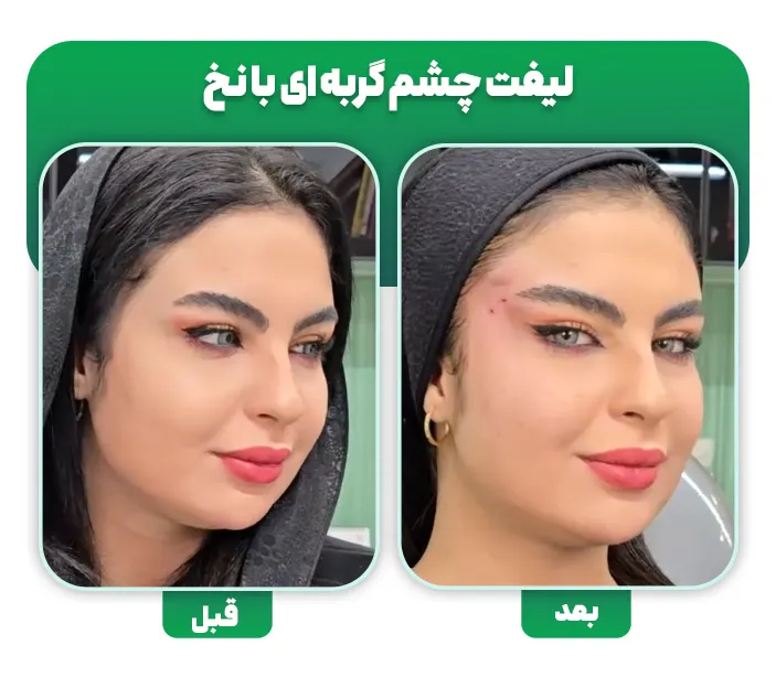 لیفت چشم گربه ای با نخ