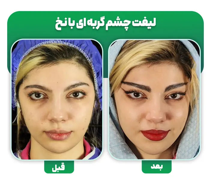 لیفت چشم گربه ای با نخ قبل و بعد